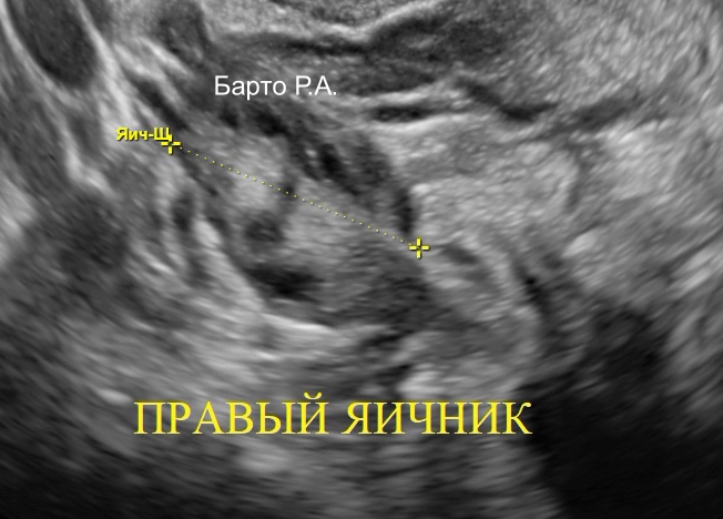 Правый яичник Барто Р.А.