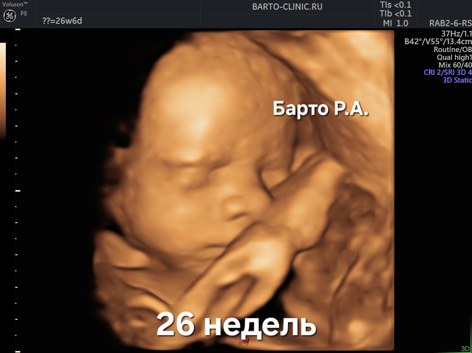 3D fetus image 26 weeks gestation