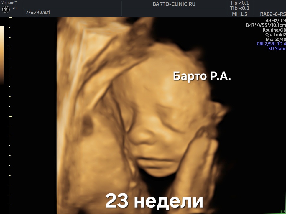3D image of a fetus at 23 weeks gestation
