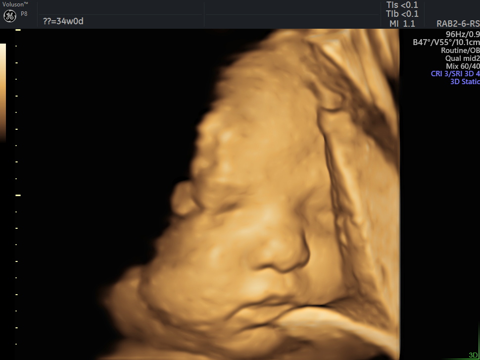 3D fetus image 34 weeks of gestation