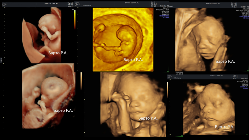 3d fetus scan