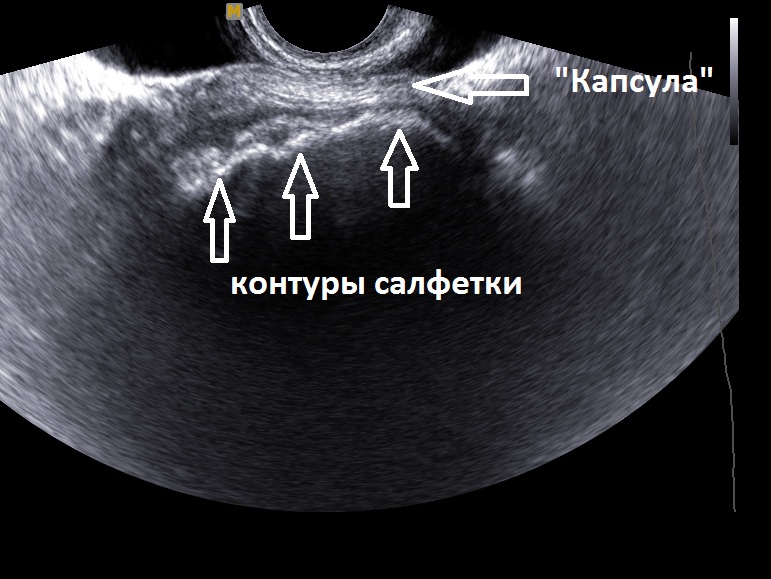 Инородное тело в малом тазу