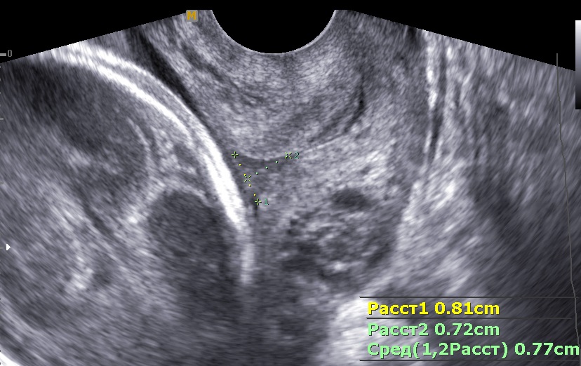сervical insufficiency or cervical incompetence