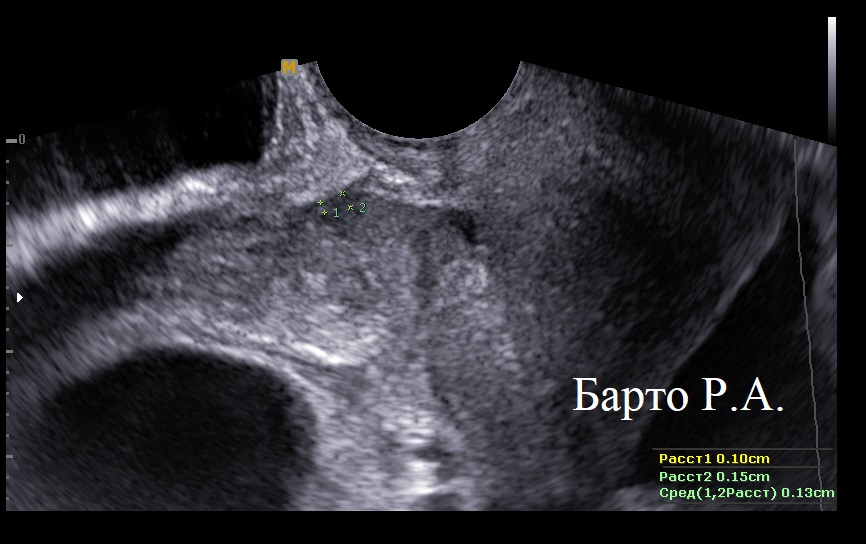 cesarean scar defect, isthmocele, niche, diverticulum or pouch, cesarean section scar diverticulum 
